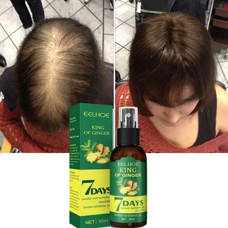 EELHOE King Of Ginger® - Spray Crescimento Capilar | Compre 2 e Leve 3